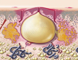 pustel_illustration.png pustel_illustration.png